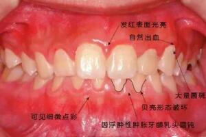 牙龈炎怎么办，引起牙龈炎的原因及治疗方法(牙龈炎图片)
